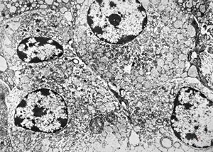 stomach- plasmocytoma